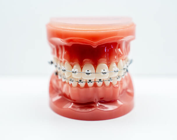 How Do Rubber Bands Work For Orthodontic Braces? - Hillsdale Orthodontics